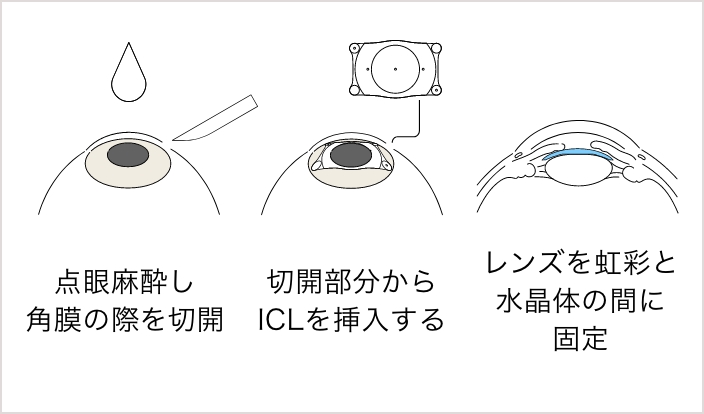 ICL手術の手順
