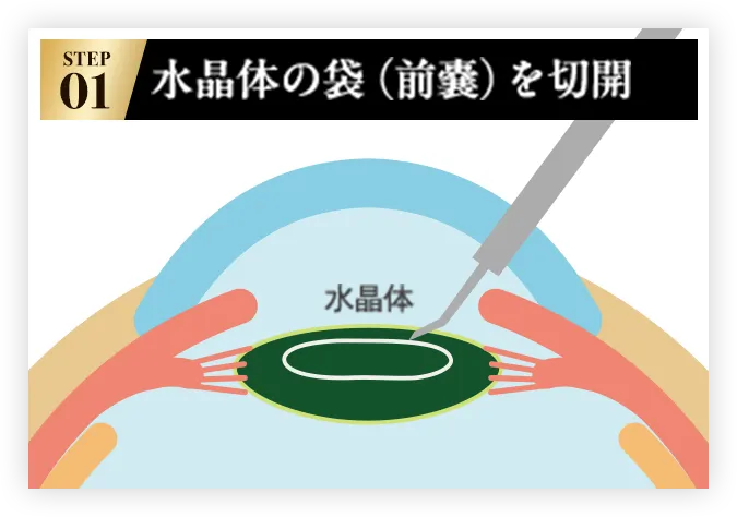 STEP01 水晶体の袋（前嚢）を切開