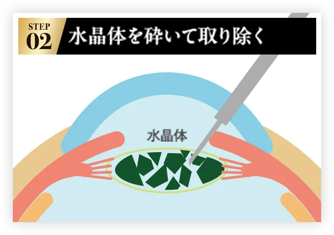 STEP02 水晶体を砕いて取り除く