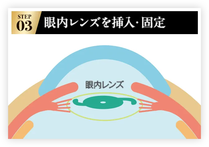 STEP03 眼内レンズを挿入・固定