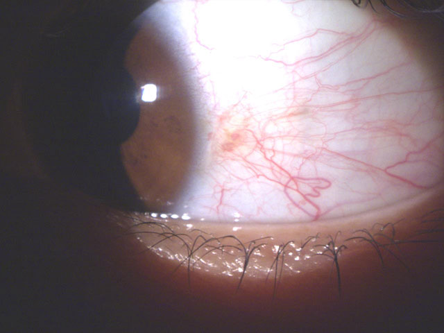 白目シミ取りレーザー手術 先進会眼科