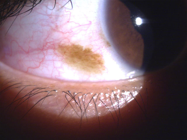白目シミ取りレーザー手術 先進会眼科