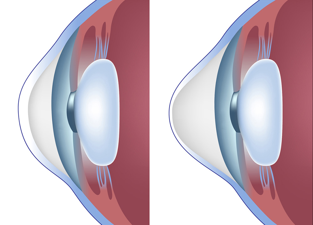 正常な角膜（左）　円錐角膜（右）