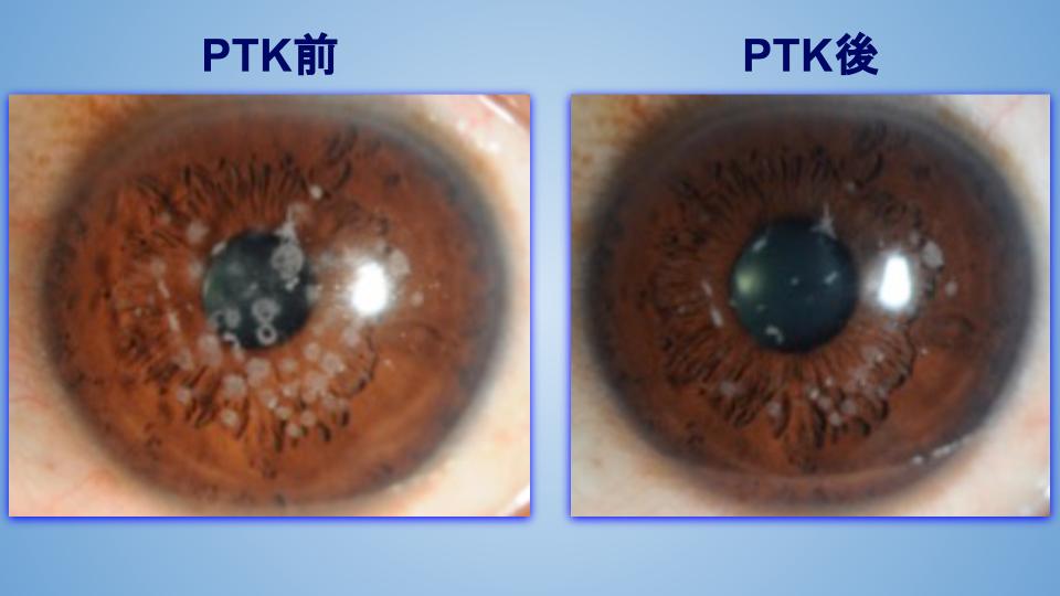 治療的表層角膜切除術（PTK）の術前後例（角膜ジストロフィー）