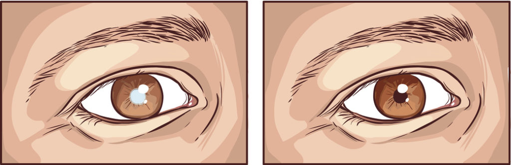 左：白内障の目　右：正常な目