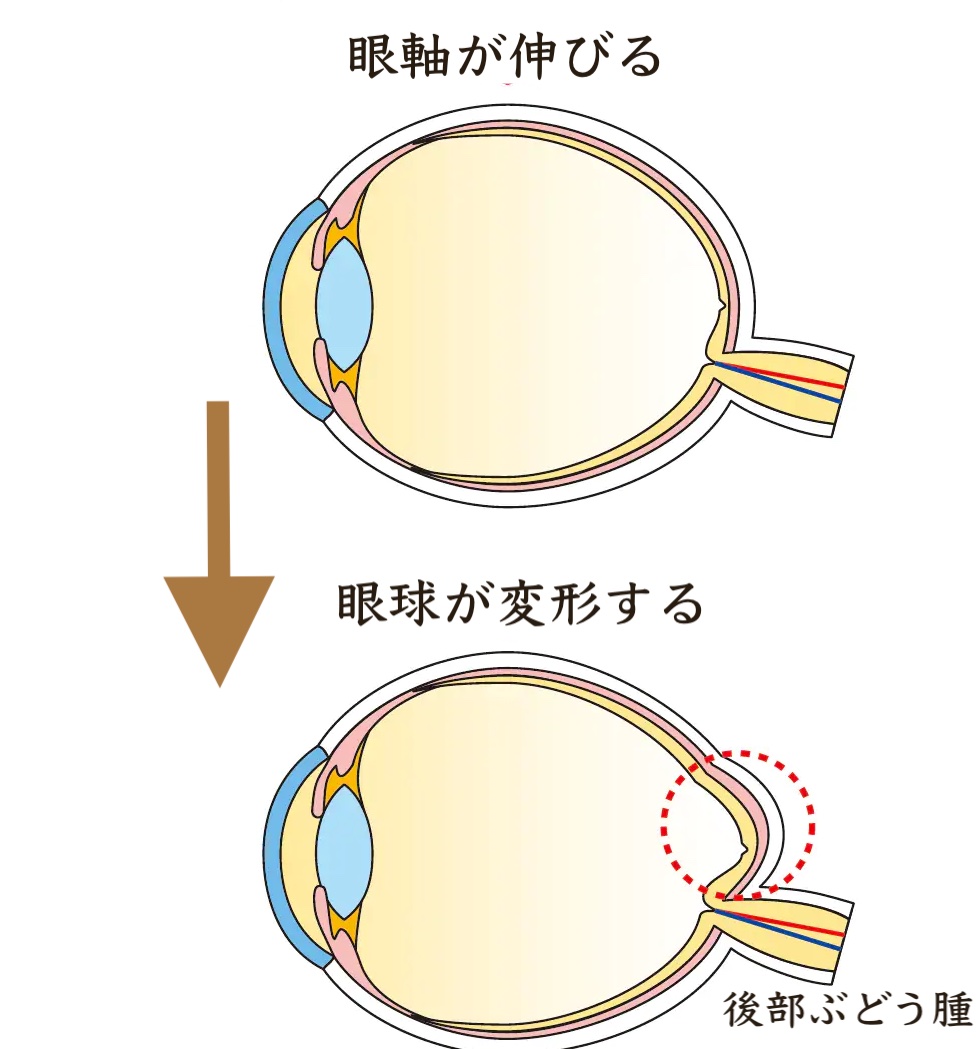 お子様の視力が思ったより悪くて焦っていますか?前編 | 先進会眼科コラム