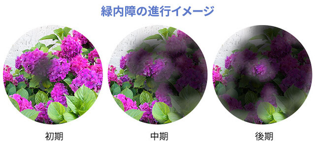 視界がぼやける、またはかすむ